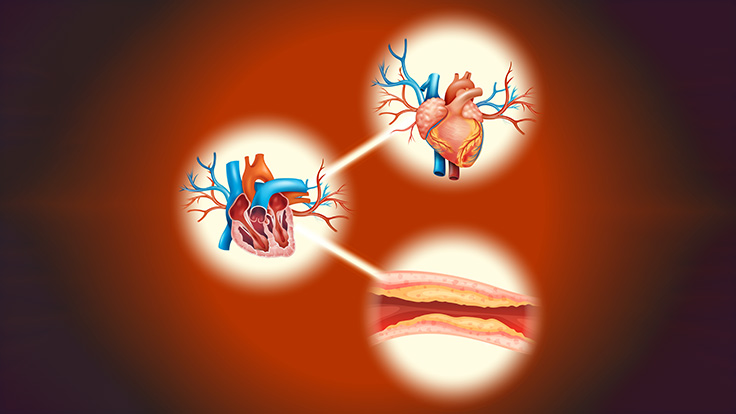 Coronary Artery Disease (CAD)  Causes, Affect, Symptoms, And Treatment